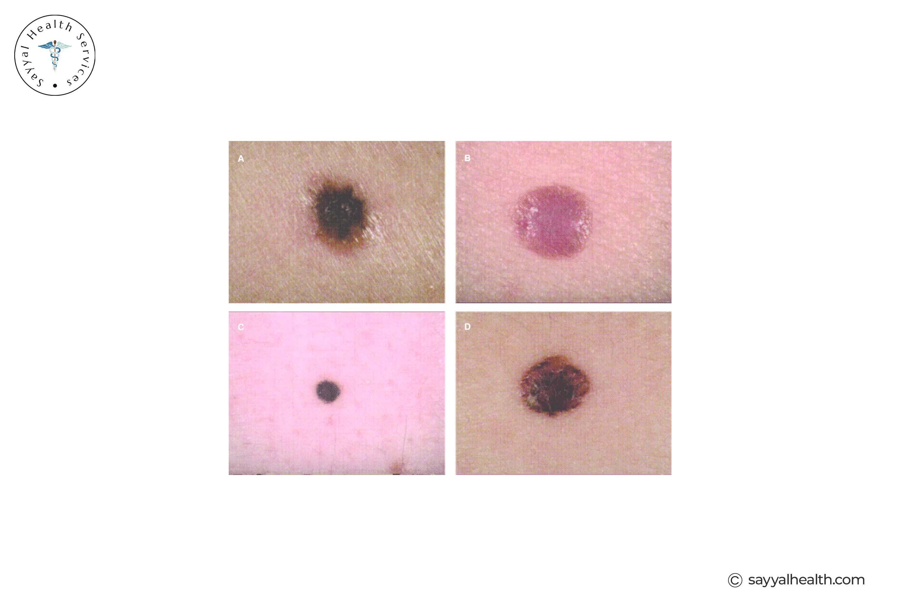 picture of nodular melanoma